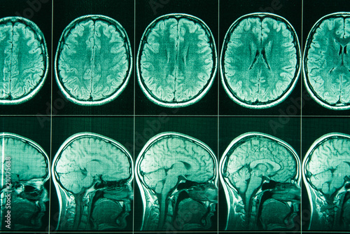 MRI of the head and brain of a person.