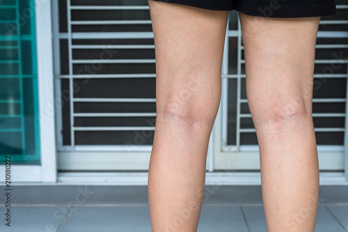 Varicose veins on the woman leg,Normal veins near the skin layer swell out,And blood is accumulated to see a bloody blue or dark purple