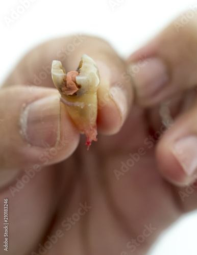 decay molar tooth in a human hand on a white background