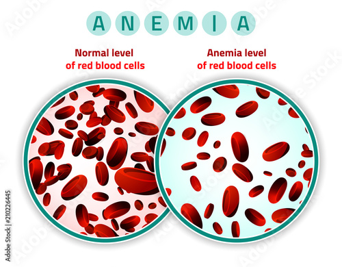 Anemia level of blood cells