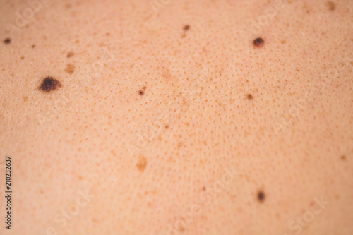 Detail of the bare skin on man in the back, Disorders of body with moles on skin growths include warts lot of wart, mole, birthmark, wart, gnarl, wart, Skin problems, Sun effect on skin.