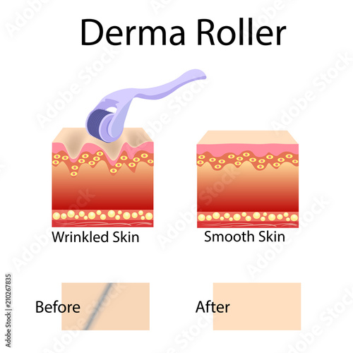 Mesorolling process and cell structure, before after effect