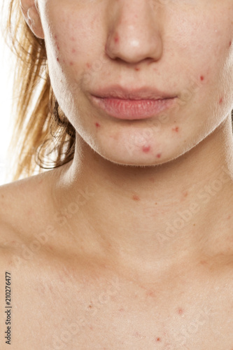 Фотография young woman with problematic skin and without makeup poses on a white background