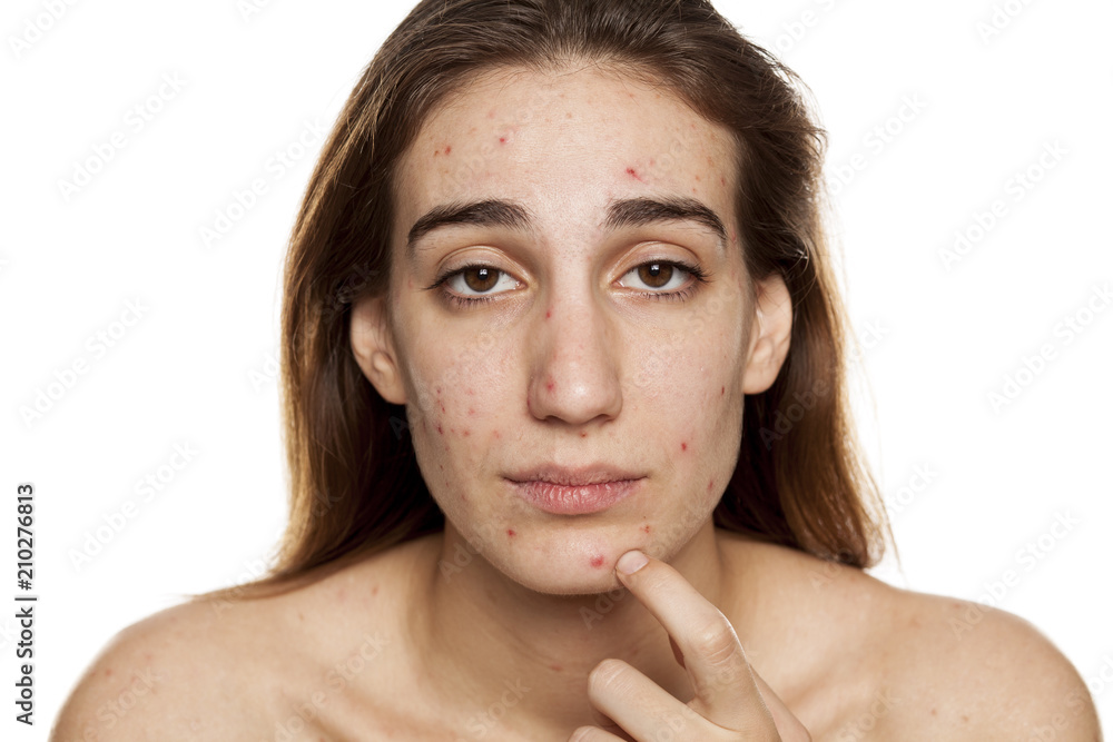 young woman with problematic skin and without makeup poses on a white background young woman with problematic skin and without makeup poses on a white background