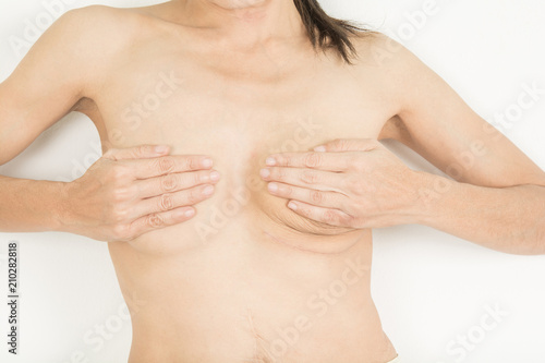 woman one breast cancer awareness  and scar from surgery