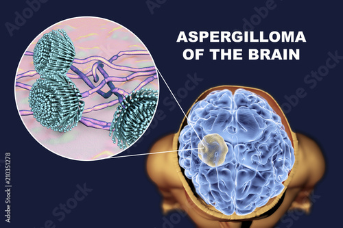 Aspergilloma of the brain and close-up view of fungi Aspergillus, 3D illustration. An intracranial lesion produced by fungi Aspergillus in immunocompromised patients photo