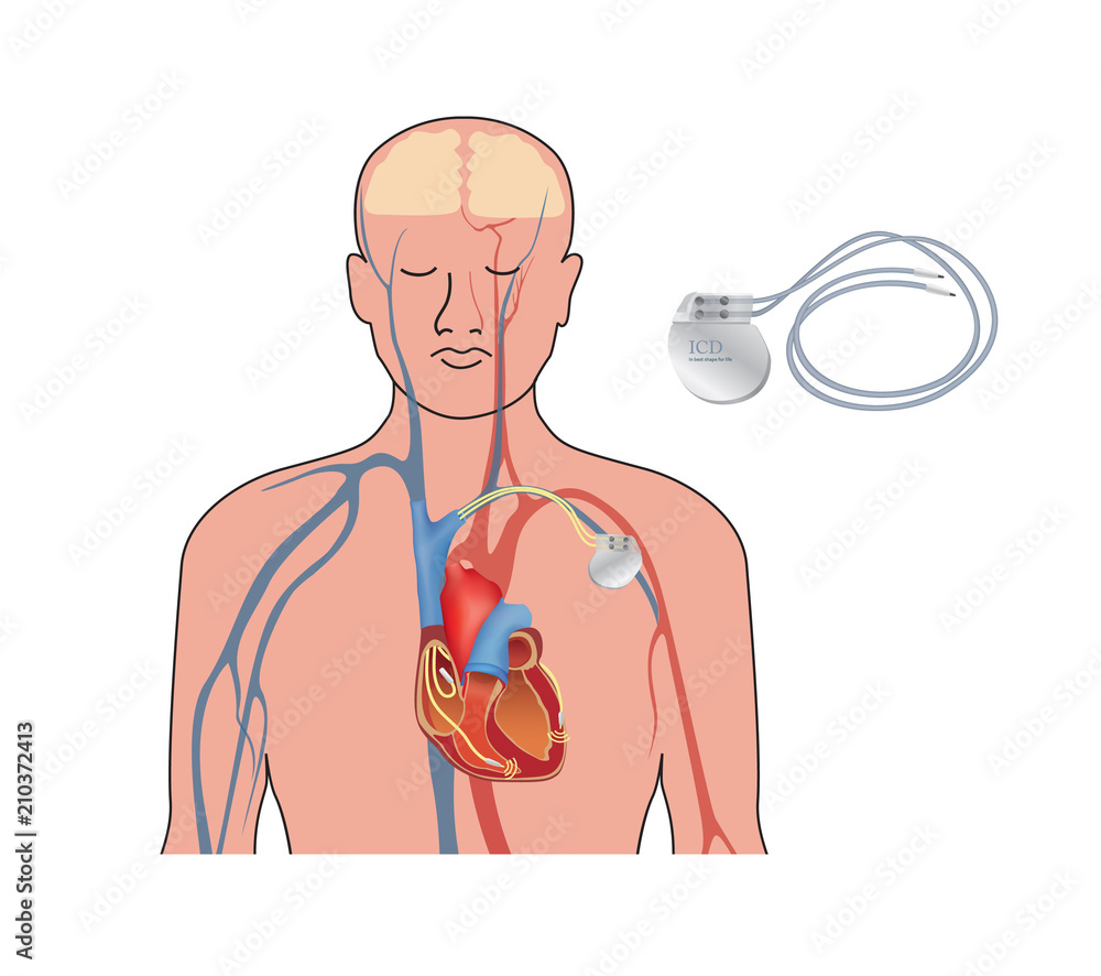Heart pacemaker in work. Human heart artificial cardiac, ICD Stock ...
