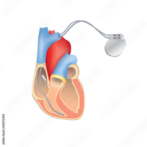 Photography Heart pacemaker in work. Human heart anatomy with ICD