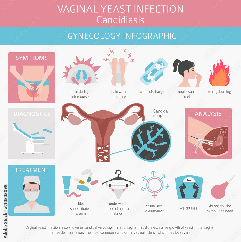 Vaginal yeast infection. Candidiasis. Ginecological medical desease ...