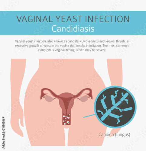 Vaginal yeast infection. Candidiasis. Ginecological medical desease infographic