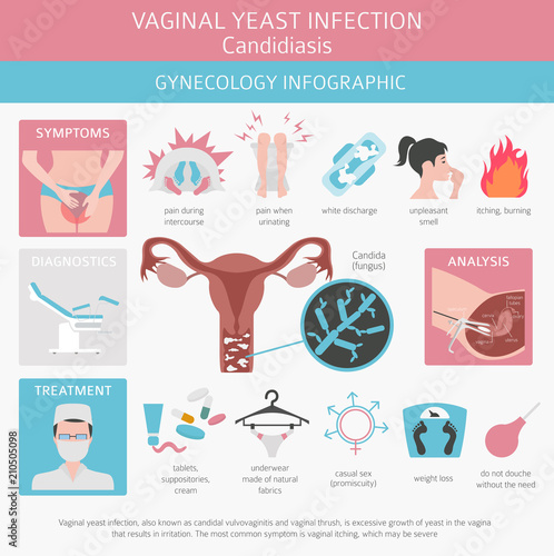 Vaginal yeast infection. Candidiasis. Ginecological medical desease infographic photo