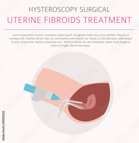 Uterine fibroids. Ginecological medical desease in women infographic