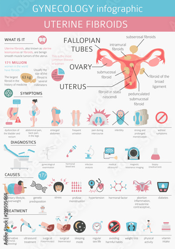 Uterine fibroids. Ginecological medical desease in women infographic