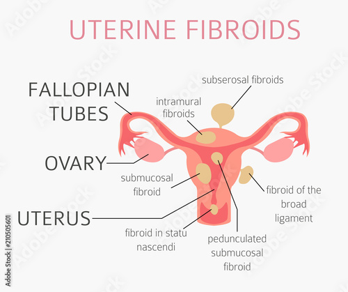 Uterine fibroids. Ginecological medical desease in women infographic