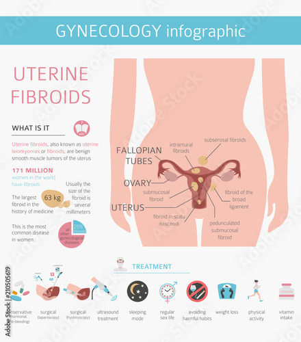 Uterine fibroids. Ginecological medical desease in women infographic
