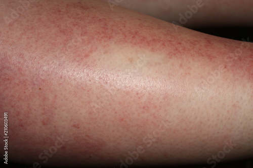 terrible sun burn on females leg that has caused sun poisoning