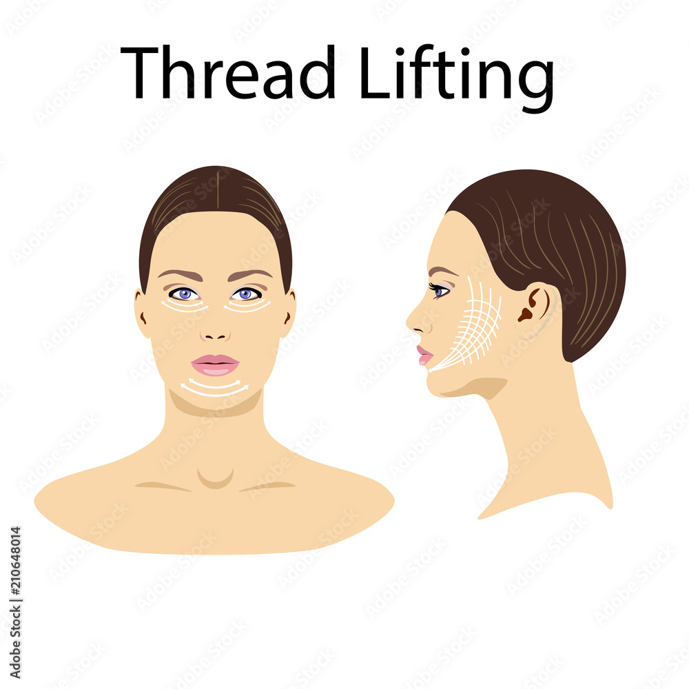 Thread lifting, vector illustration, face of a girl Thread lifting, vector illustration, face of a girl