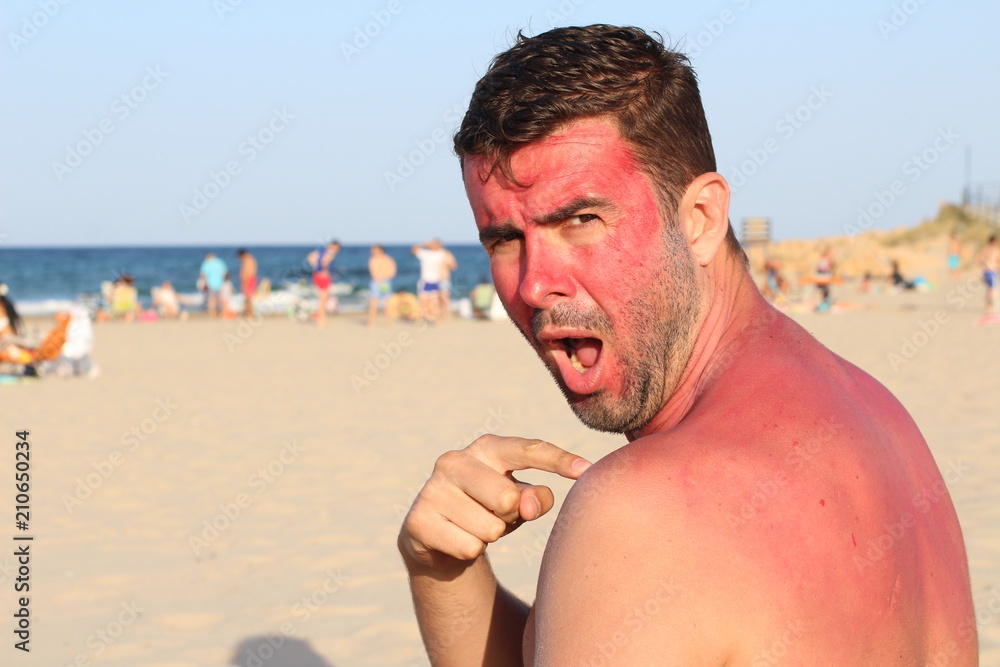 Фотография Man getting sunburned at the beach