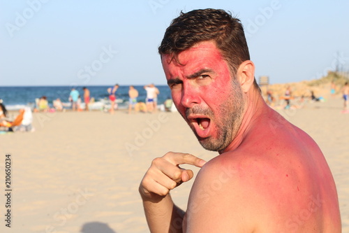 Man getting sunburned at the beach