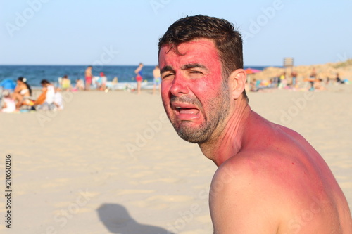 Man crying after getting wildly sunburned 