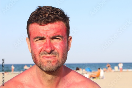 Man with lost of redness after suntanning