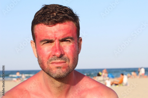 Man with serious expression after getting sunburned 