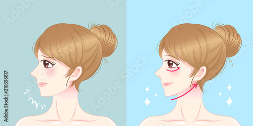 woman with lifting lines