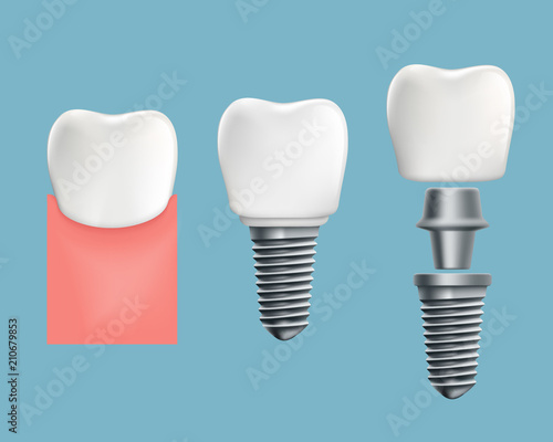 Schematic infographics of human teeth and dental implant