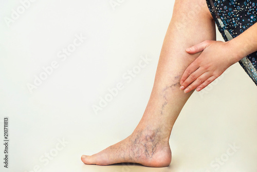 Varicose veins on the womans legs photo