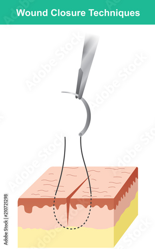 Wound closure techniques Isolate. Illustration infographic.