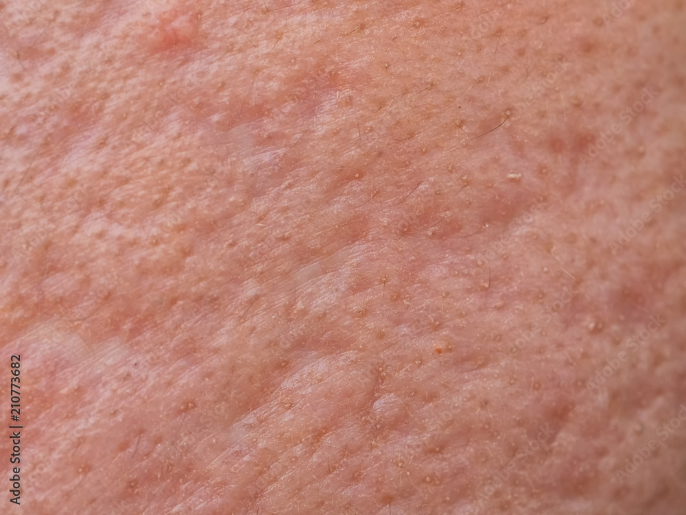 closeup skin problems, nodular cystic acne skin