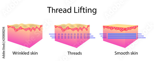 Thread lifting, vector illustration and skin cells, before after effect