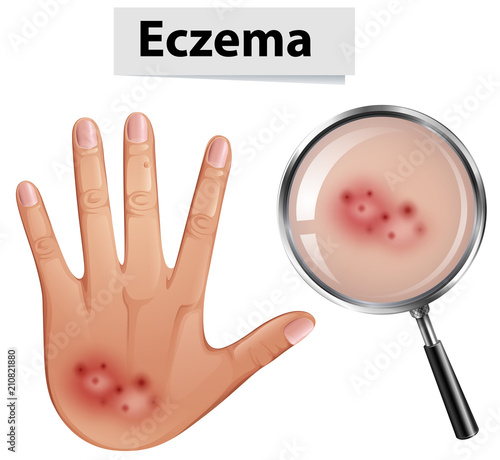 A Human Hand with Eczema