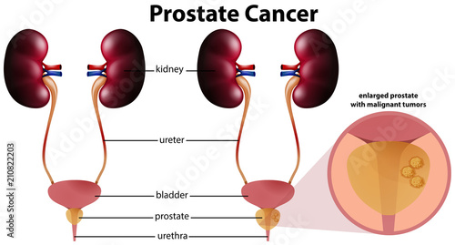 Prostate Cancer on White Background