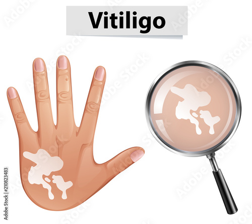 Human Hand and Vitiligo