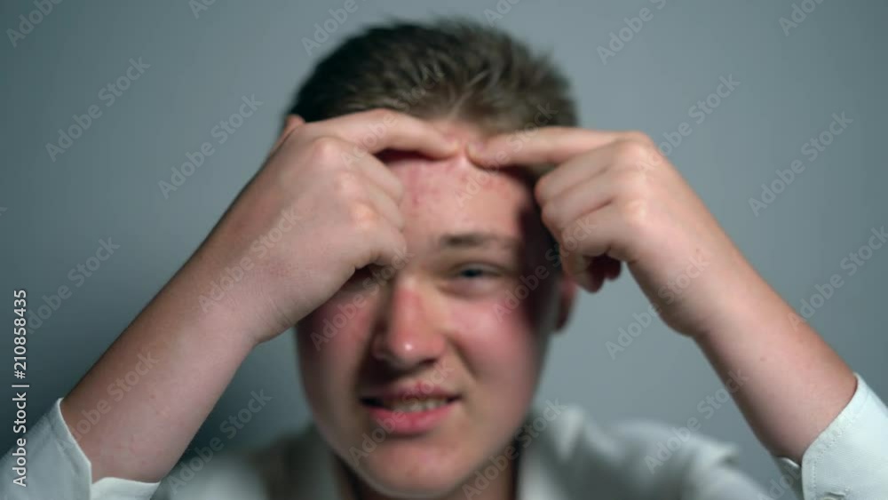 Young man squeezes the pimple on the face in front of the mirror. Closeup man's face with skin problems. Young man squeezes the pimple on the face in front of the mirror. Closeup man's face with skin problems.