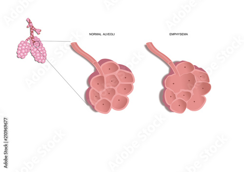 normal, healthy alveoli (lungs) and with emphysema
