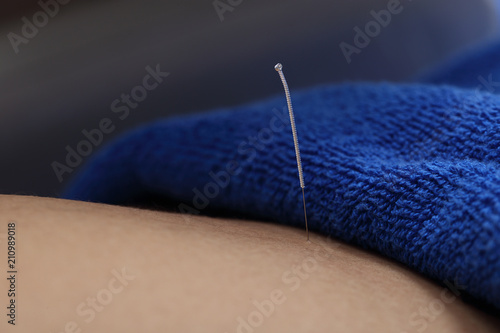 Close up Hand Perform Medical of professional acupuncture treatment