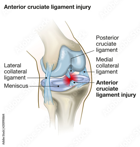 Photography Anterior cruite ligament injury, with caption