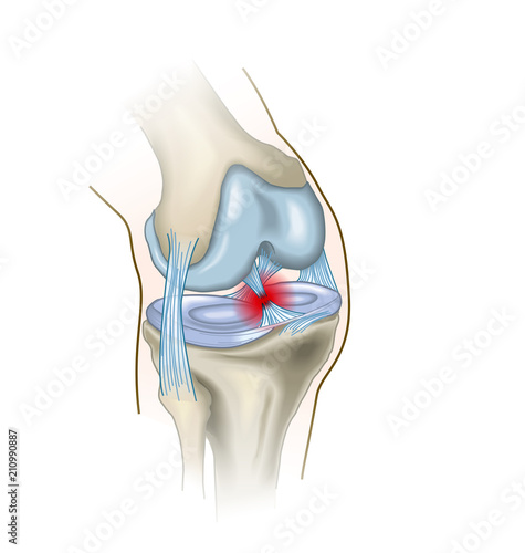 Schilderij op canvas Anterior cruciate ligament injury, medical illustration