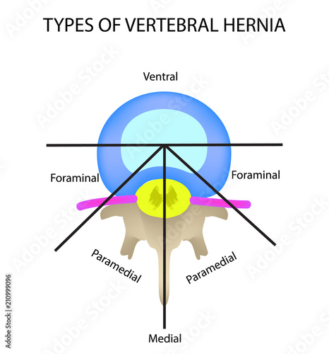 Types of location of the intervertebral hernia. Vector illustration on isolated background.