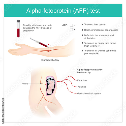 Alpha-fetoprotein (AFP) test. Use Analysis by AFP level. to detect liver cancer, and use to screen for down’s syndrome.