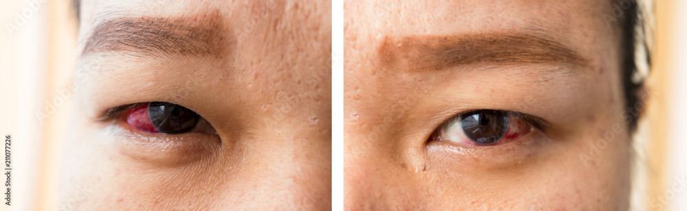 Naklejka premium woman with problem on red eye infection