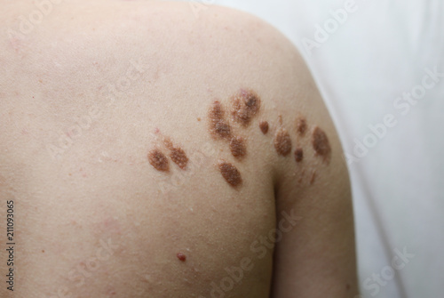 Big birthmarks and freckles on the girl's skin. Medical health photo of woman's beck. photo