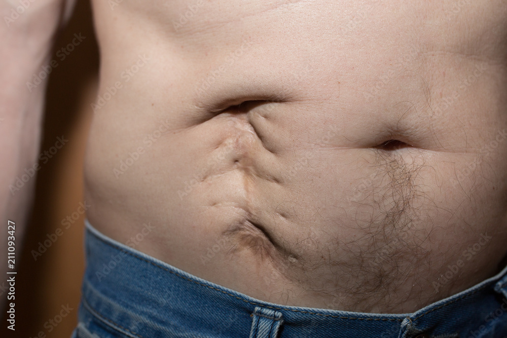 Appendicitis Scar Belly Button