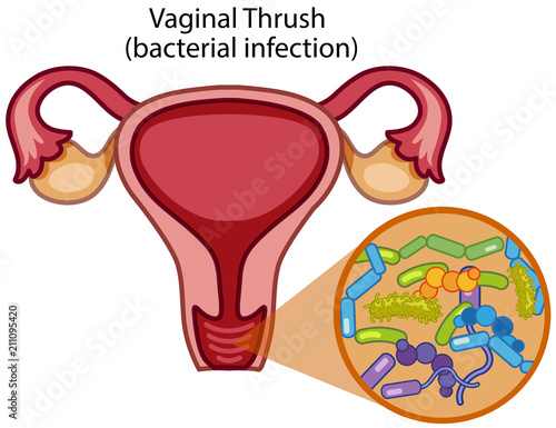 Vaginal Thrush on White Background