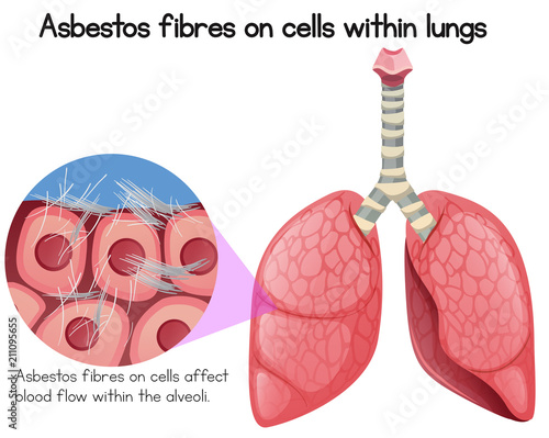 Asbestos Fibres on Cells Within Lungs