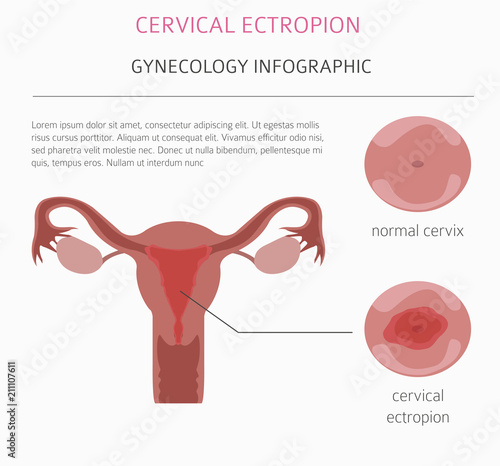 Cervical ectropion. Ginecological medical desease infographic