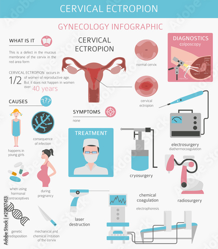 Cervical ectropion. Ginecological medical desease infographic