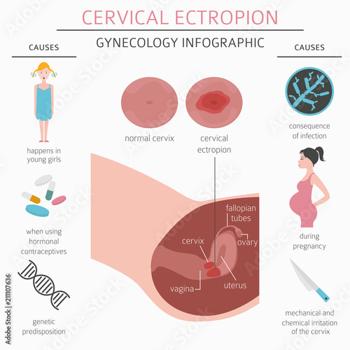 Cervical ectropion. Ginecological medical desease infographic